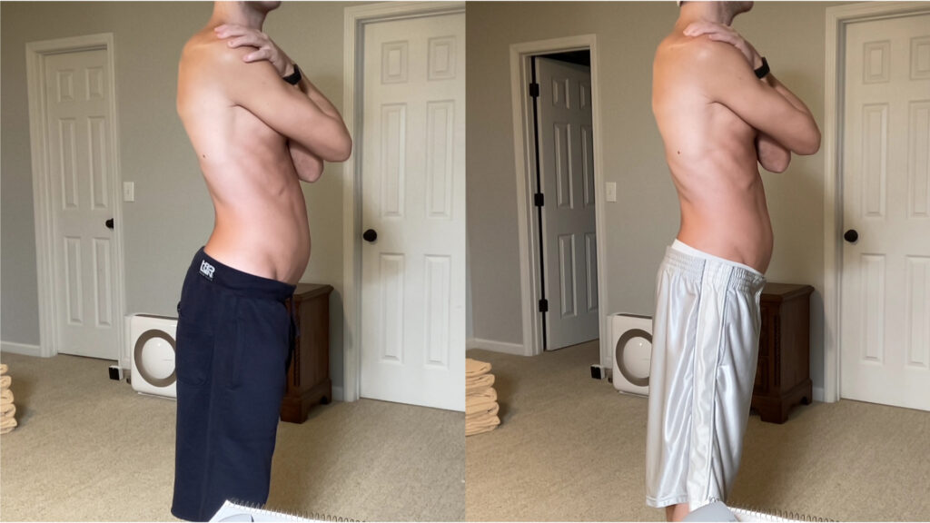 Andrew's Anterior Pelvic Tilt Before and After